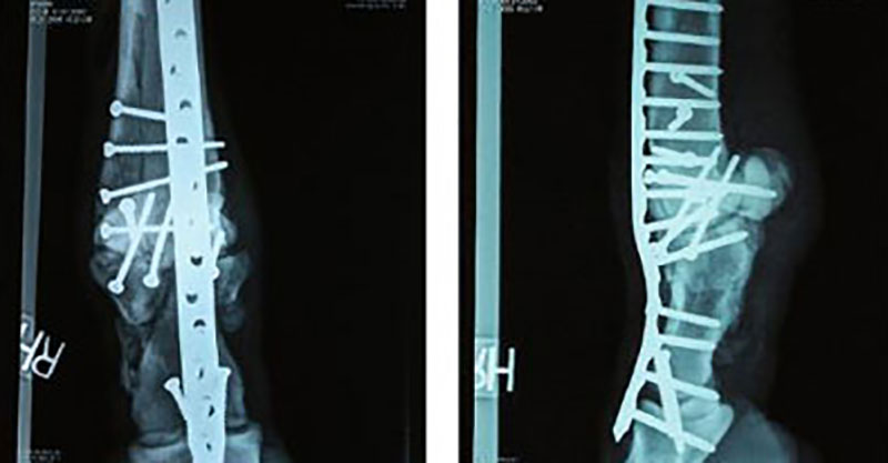 gymnastics-broken-bone
