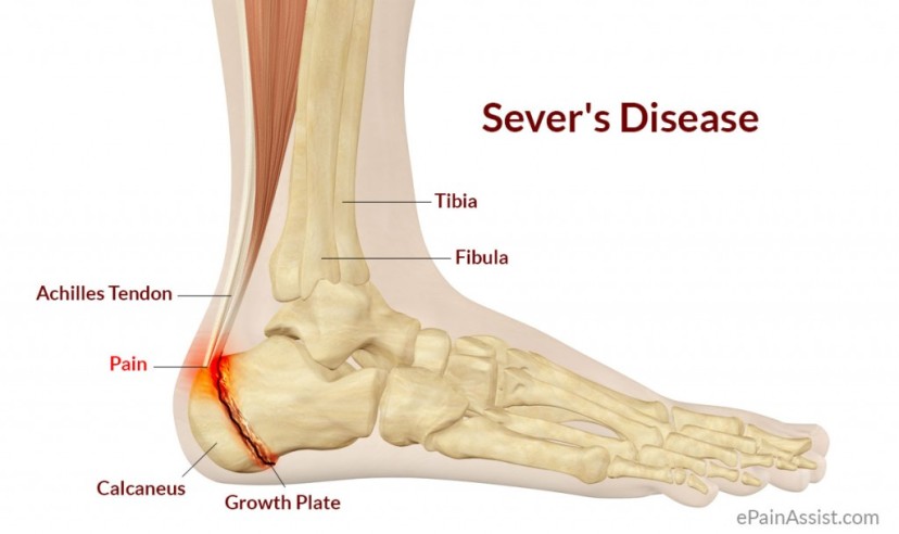 common heel problems